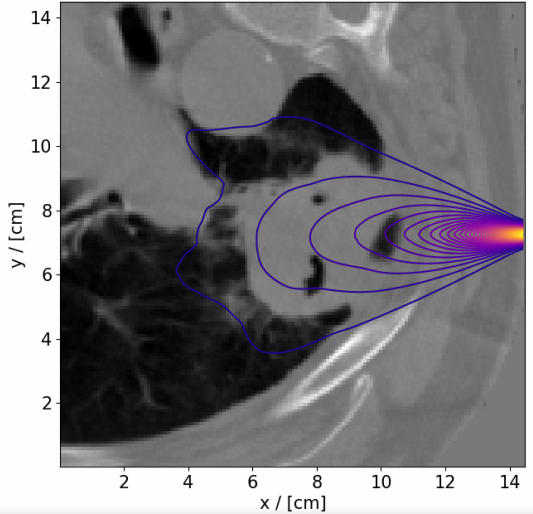 radiation therapy